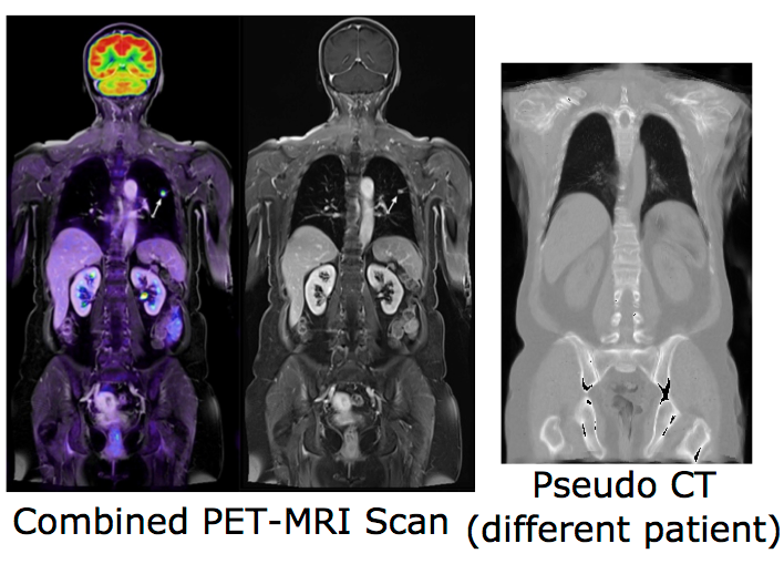 MRI-based CT Synthesis